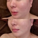 남구-61 | 부산 용호동 피부관리 추천 하이푸 리프팅 남구 닥터파우제 에스테틱