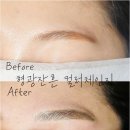 인천 눈썹문신제거 전문 🤍 브로우리아 형광잔흔 제거 1회차 직후 컬러체인지