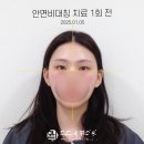 청담한의원 | 턱관절 장애 보유자의 안면 비대칭 교정 후기 (feat. 청담 한의원)