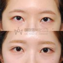 소망의원 옆 | 눈 재수술 355. 비절개 눈매교정술 후기, 쌍수 라인, 짝눈 교정