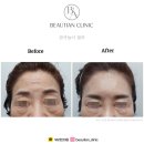 뷰리안의원 | [뷰리안 시술 전후사진]부산 남구 용호동 피부과, 부산 필러/용호동 필러/경성대 필러/필러 가격/필러 후기