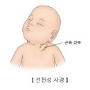 ﻿선천성 사경 (Congenital (sternomastoid) torticollis) 이미지