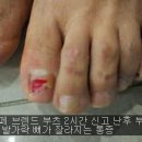 노원 롯데 백화점 미소페 부츠 신고 난후 발가락 부상 사진 이미지