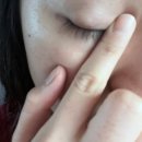 김동철안과의원 | 1년 묵은 지독한 다래끼 수술후기…🔪🏥