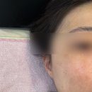 구미 산동피부관리 에이원뷰티 아쿠아필 플라즈마 솔직 후기