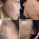 뷰티스톤의원 | 광교 피코슈어 기미 제거 뷰티스톤 15회 솔직후기