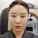 (주)누라임소프트 | 신사피부과 실루엣소프트 심부볼 리프팅 +10일차 후기