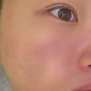 수영센텀피부과의원 | [부산 해운대/수영 피부과] 여드름관리 PN주사 리쥬란 받고온 내돈내산 후기