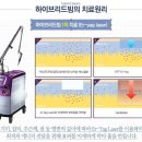 대구 하이브리드빔 레이저 주근깨 기미 홍조 효과굿 이미지