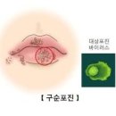 구순포진 원인과 증상 치료방법, 연고 이미지