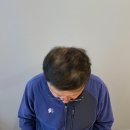 중앙로 349 | [영종도 두피문신] 70대 남성 탈모 커버 SMP 1회차 후기 (5주간의 변화, 그 첫걸음!) / 스칼프&amp;스킨 디자인