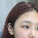 제스타성형외과의원 | [코성형/코수술]2주차 D+14 내돈주고한 내코, 제스타성형외과 코수술 후기 / 실밥제거