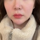 뿌리깊은한의원 | 명동한의원 팔자주름 실리프팅 후기 매선실리프팅 잼버실 팔자 리프팅