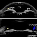 녹내장 간단명료하게 생각하기: ‘GIFT’ (1) – 녹내장의 종류 이미지