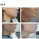 오썸성형외과의원 | 이중턱 지방흡입, 이중턱 실리프팅 후기, 땅콩 얼굴형에서 계란형 얼굴 갖기(+9개월 사진)