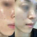 [광고❌]모낭염•여드름•생리전여드름 극복기 l 15년 여드름 피부의 모든 치료기