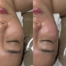 벨보뜨 테라피 | 수유 피부관리 슈퍼젝션으로 피부 미인되고 어깨 곰은 사라지는 벨보뜨테라피