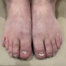 새론정형외과의원 | 못생긴 평촌 내성발톱 무좀 병원에서 깔끔하게 치료