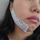 계성메디칼 | 매복사랑니 발치 후기(1~4일차)