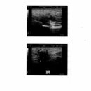 29세 palpable mass core bx 결과입니다. 이미지