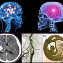 뇌졸중에 대하여 이미지