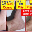 피부병 치유의 새로운 전기 장 남철 박사 이미지