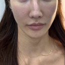 준성형외과의원 | 바이준성형외과 코성형후기 (콧구멍에 코솜안넣는 병원) 내돈내산 3주차~3개월 수술후기