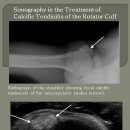 Sonography in the Treatment of Calcific Tendinitis of the Rotator Cuff 이미지