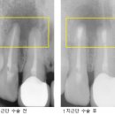 치근단 수술[Apical surgery] 이미지