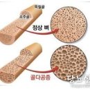 골다공증 원인 증상 검사 수치 낫는법 이미지