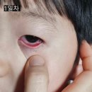 내원어린이집 | 아이 결막염 I 증상 전염 안약 치료 어린이집 격리기간