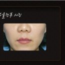 지방이식 수술전후사진-팔자주름,귀족수술 자가지방이식[대구지방이식] 이미지