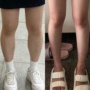 하이힐 | 청담동 피부과 종아리 보톡스 | 지방분해주사 [하이힐주사] 찐만족후기✨