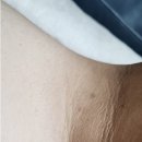 15년 묵은 남성 쥐젖 한방에 해결 !! 시술전후 사진 O 최종판 후기3 <대전 코코마쥬 실면도 대전본점>