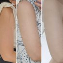 MJ올피부과 | 명동 피부과 예신 팔뚝 지방분해 주사 4회차후기