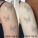 정피부과의원 | 강남역 피부과_팔 문신제거 5회차 시술 후기(+나세르의원, 전후 사진)