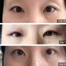 최희윤성형외과의원 | 강남역 컴포트성형외과 반영구 아이라인 문신제거 1회 시술 두 달 후 변화