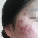 거당한의원 | 여드름치료후기 &#34;진짜&#34;인 곳 다녀봤어요