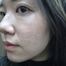 하이주 | 명동 피부과 명동 리쥬란 힐러 스킨부스터 하이주 물광주사 내돈내산 후기
