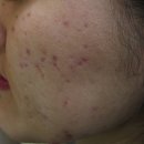 차오름한의원 | 리유한의원 가격 내돈내산 여드름흉터 치료 후기 공유해요