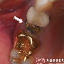 서울훈훈한치과의원 | 수면 치료 추천 받고 광진구 자양동 치과 오신 환자의 고난도 뼈이식 임플란트 수술 후기