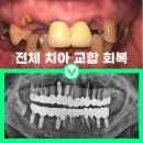 유라치과의원 | 우래동래치과 치아 상실과 다수 임플란트 치료 후기