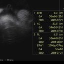 이마트24군문주공점 | 임신 34-35주차 조기진통 자궁수축으로 입원 4주차 후기,,다시 트랙시반(비급여)으로!ㅠ