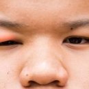 눈다래끼 초기증상 자연치료 눈다래끼 전염 찜질 방법 이미지