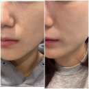 아꼴에 | 종로피부과 주근깨제거 리얼후기 아꼴레이드 후 토닝 1회차