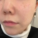 나비피부과의원 | 강남피부과 얇은피부탄력에 좋은 소프웨이브 한달후기 착한 다이어트약처방