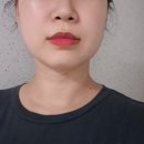 목필러 시술받은지 1년후에 목주름 자가진피재생술 받으러 온 후기