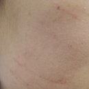 피네의원 | 신사역 피부과 추천 인모드fx 후기 효과 멍 부작용 주기 💁‍♀️