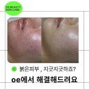 까만코 | 까만 점 빼도 안 사라지는 코, 어떻게 해야 할까?