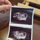 아임 메디칼 | 7주차 계류유산 소파술 후기 (늦은착상? 성장지연? 무배아임신? 피검수치?)